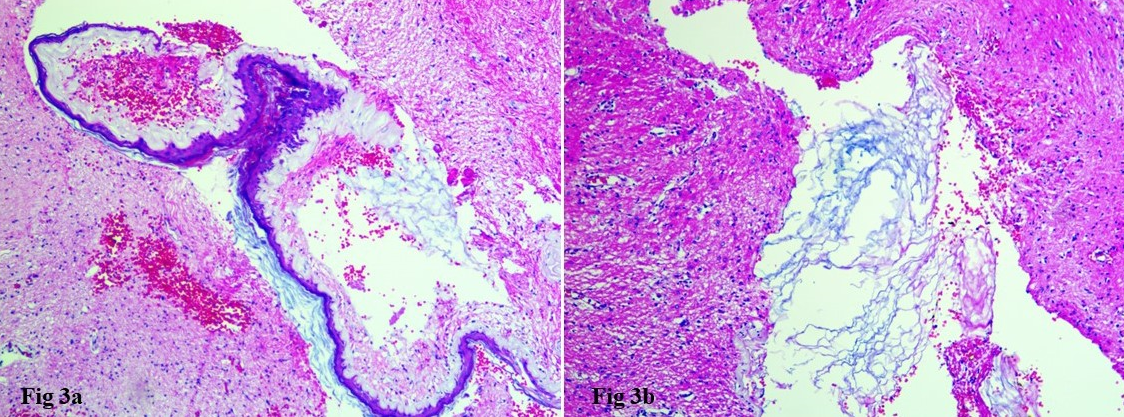 a: Histopathology showing a cyst wall lined by stratified squamous epithelium (HE, 100x); b: Showing lamellated keratin flakes within the glial tissue (HE, 100x)