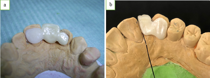 a: Ceramic resin bonded bridge with two retainers; b: Ceramic cantilever bridge with a single retainer