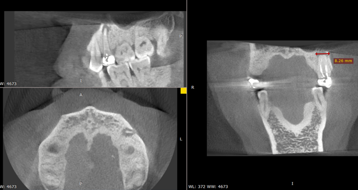 CBCT examination in axial, sagittal and coronal slices.