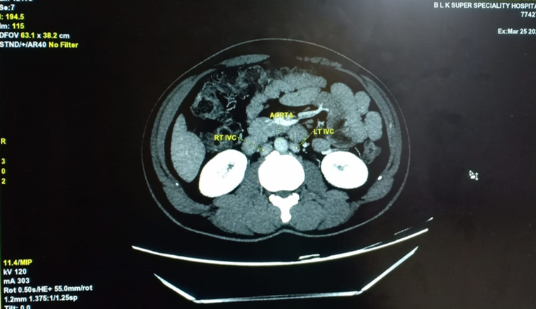 Axial MDCT image show right and left infrarenal IVC on either side of aorta below L2 vertebral level.