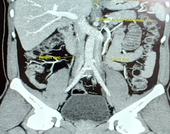 Coronal MDCT MIP images show duplicated infrarenal IVC with left IVC segment crossing the midline in front of aorta to form the suprarenal common trunk.