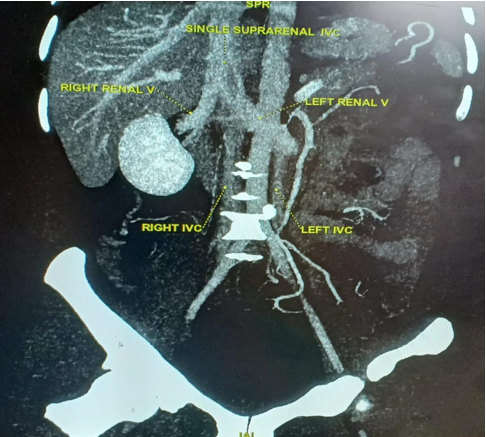 Coronal MIP images show duplication of IVC in the infrarenal part with drainage of right renal vein into the common trunk and drainage of left renal vein into the left IVC segment.