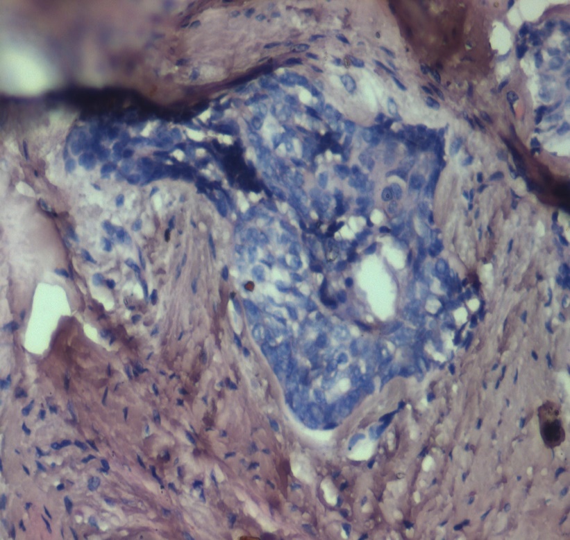 Photomicrograph showing squamous metaplasia in follicle surrounded by desmoplasia (×40) (H and E)
