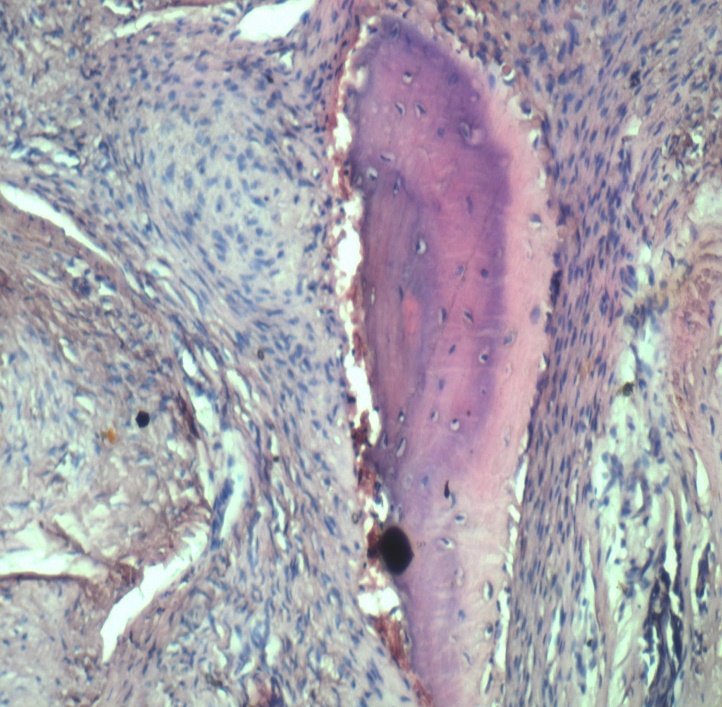 New bone formation in between the squamous epithelial cells within the lesion (H & E stained section, magnification x20)