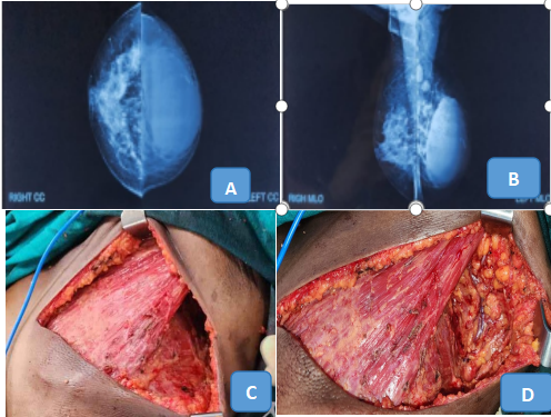 (A & B) a heterogeneous dense breast with an irregular, high-density mass having oblong component noted in retroareolar region in the center-left breast involving anterior and middle depth with indistinct margin. (C & D) Intra-operative picture after modified radical mastectomy with axillary clearance and showing thoracodorsal bundle preserved with axillary lymph node dissection