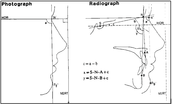 The transfer of true horizontal (HOR) from photograph to radiograph. 3