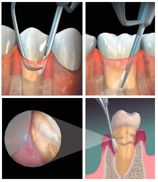 Perioscope tip inside the gums showing enlarged view of gums.