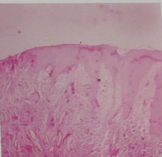 Histopathology images –Telangiectatic granuloma