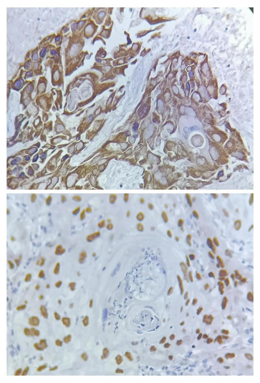 Immunohistochemistry: Tumor is positive for ck5/6 and p40.