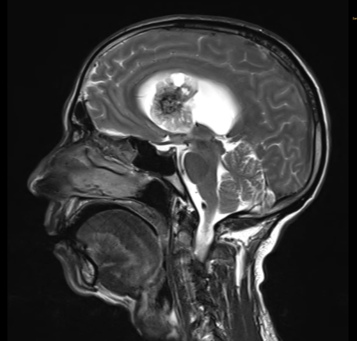 MRI showing well-defined heterogeneously enhancing lobulated altered signal intensity lesion arising from septum pellucidum