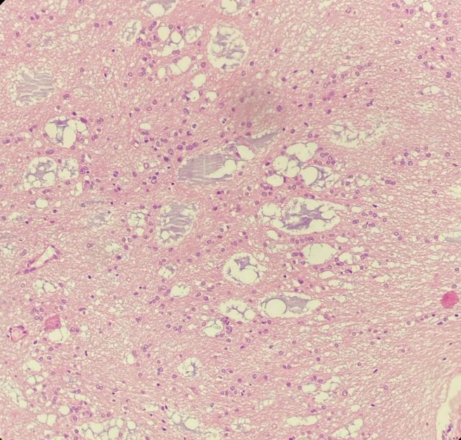 Neurocystic cells are having small round nuclei with fine stippled chromatin and scant cytoplasm in abundant myxoid stroma. The neurocystic cells are present in partly microcystic arrangement.
