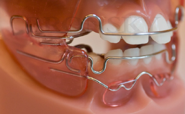 Passive expansion with vestibular shields