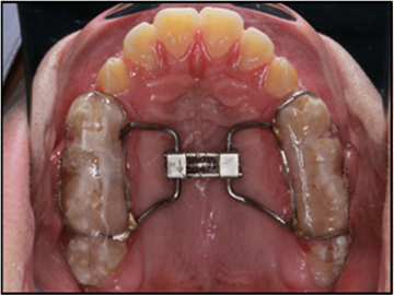 Bonded HYRAX appliance