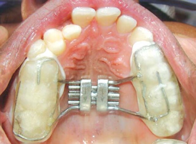 Palatal expansion screw