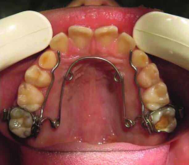 Quad helix appliance
