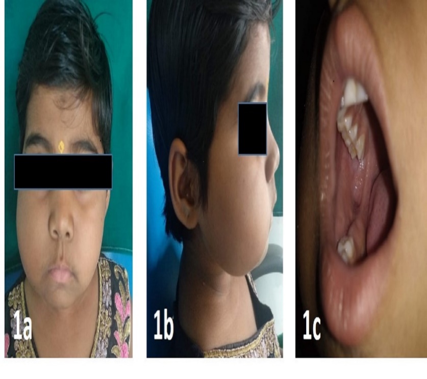 Showing intraoral and extra oral swelling.