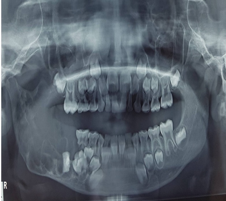 OPG showing well-defined, multilocular radiolucent lesion on right posterior mandible
