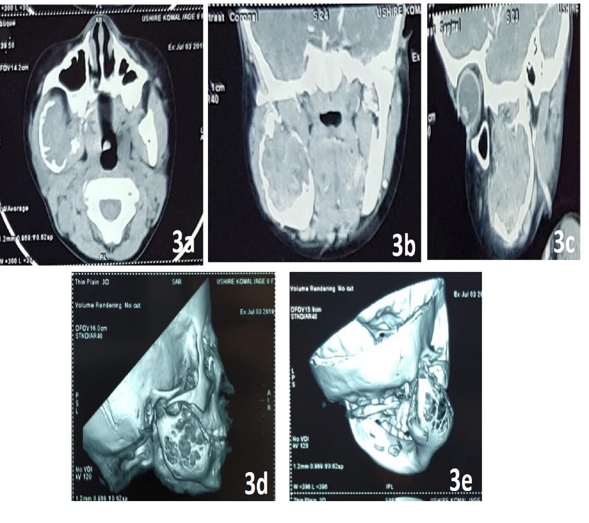 CT images showing well-defined, expansile, osteolytic lesion.