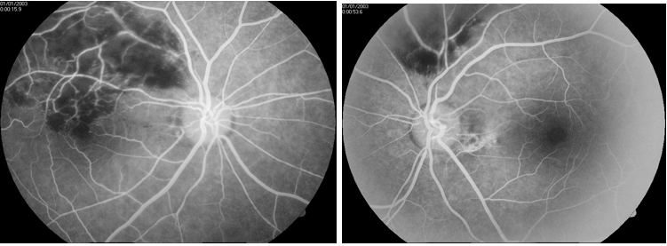 Fundus fluorescent angiography of  both eyes.