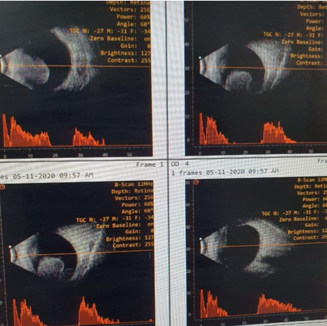B-scan image showing the lesion