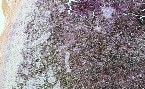 Photomicrograph showing features of mixed cell type of malignant melanoma (with hematoxylin-eosin staining).