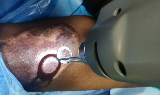 Erbium YAG laser session in progress at donor site (thigh) of skin grafting