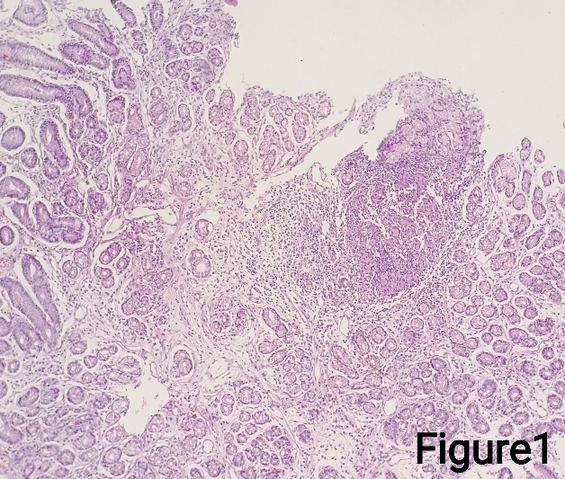 Gastric biopsy showing gastric mucosal glands, laminapropria and granuloma (H&E stain)- 100X