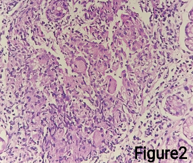 Granuloma withLanghan-type giant cells (H&E stain)- 400X