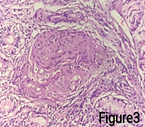 Gastric biopsy showing granuloma (H&E stain)- 400X