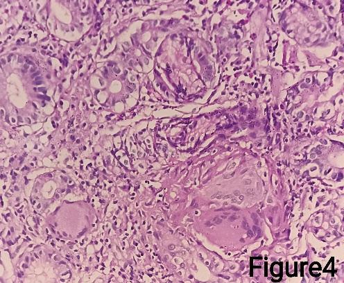 Gastric biopsy showingLanghans type giant cell (H&E stain)- 400X