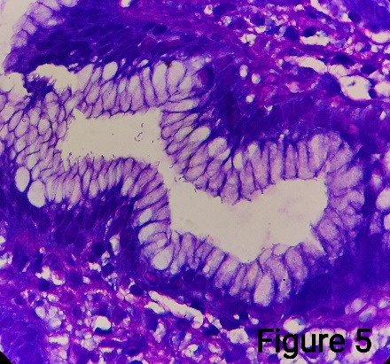 Gastric biopsy showingH.pylori (Giemsa stain)- 1000X