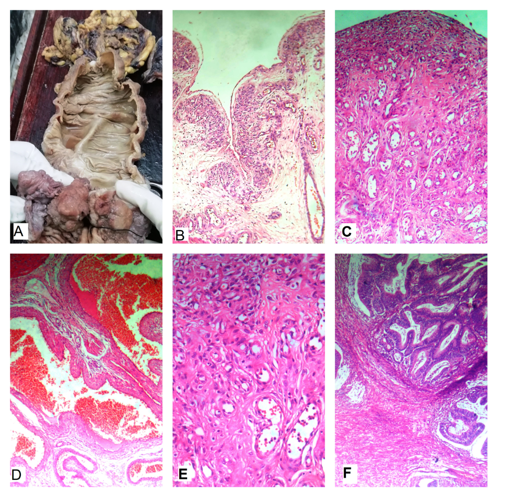 a): Gross photo of Hemicolectomy specimen showing polypoidal growth and shiny greyish lesion noted; b): Lobular proliferation of capillary sized vasculature, H&E stain, 40X; c): Lobular proliferation of capillary sized vasculature, H&E stain, 40X; d): Large irregular dilated & congested vascular channels, H&E stain, 200X; e): Lobular proliferation of capillary sized vasculature, H&E stain, 200X; f): Tubulo-villous adenoma with foci of invasion into submucosa, H&E stain, 200X.