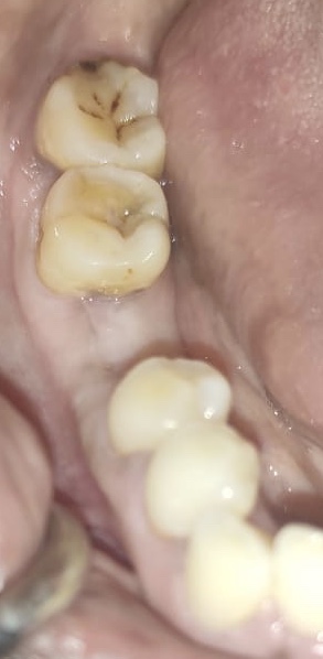 Pre-operative view in relation to 46