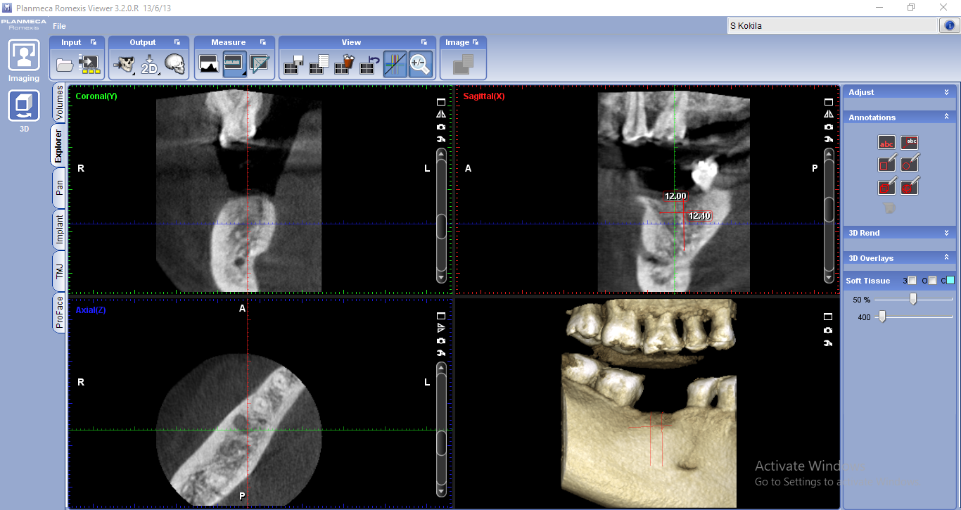 CBCT in relation to 46 showing adequate bone height and bone width