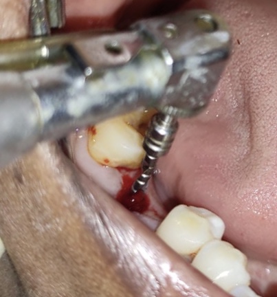  Osteotomy site prepared in relation to 46