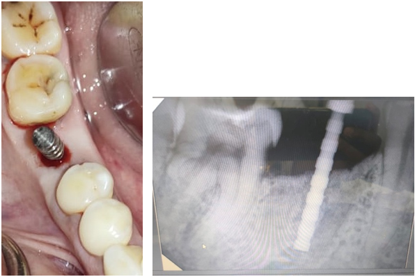 Parallelism checked in relation to 46 after initial drilling of the osteotomy site