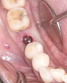 Implant placed in relation to 46
