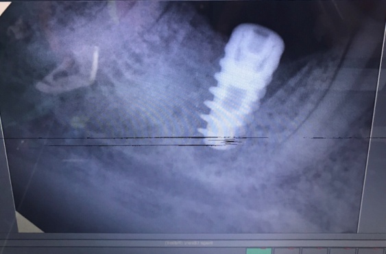 Immediate Post-operative radiograph after implant placement in relation to 46