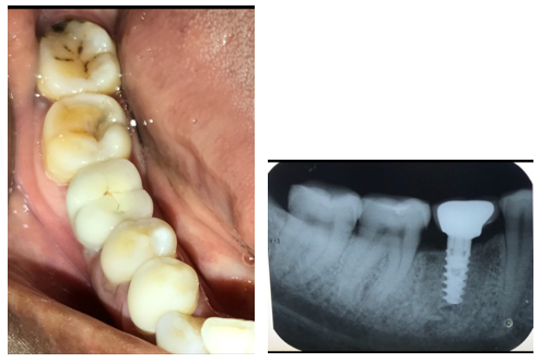 Final restoration done after 4 months and IOPA taken immediately after restoration of 46