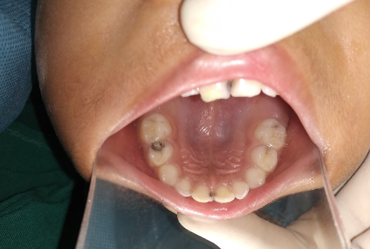 Preoperative clinical appearance of cavitated tooth 