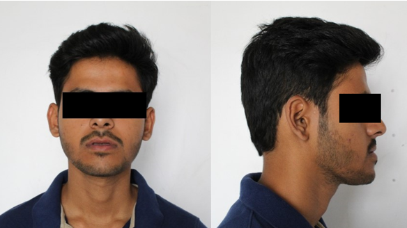 Extraoral frontal and lateral picture showing mandibular prognathism