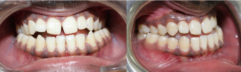 Showing the reverse overjet