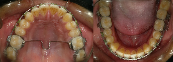 Showing the orthodontic compensation before surgery