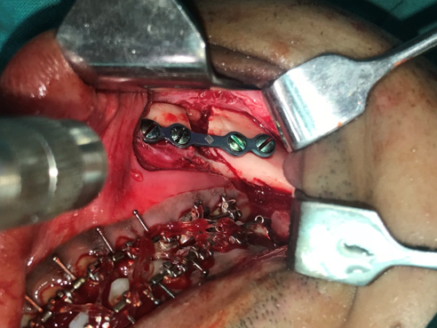 Showing the setback of 5 mm