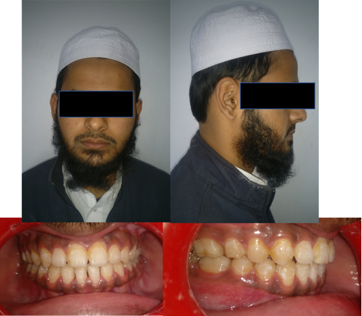 Showing the post op after debonding