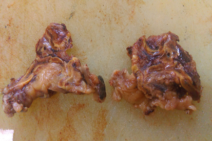 Bilateral adrenalectomy