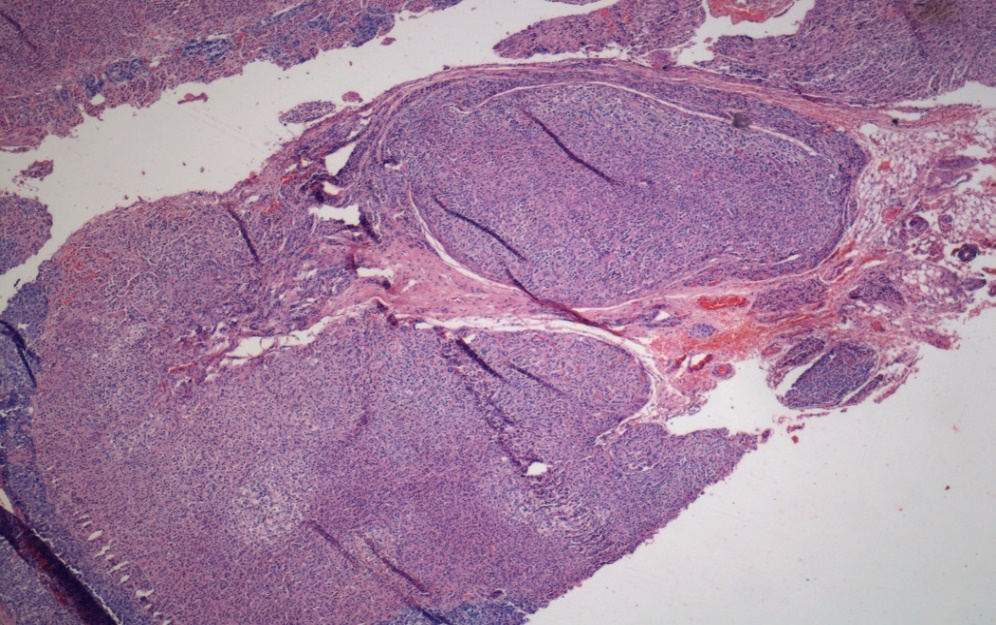 [H & E 10 X] Adrenal cortex - unencapsculated nodules beneath and abutting capsule composed of clear vacuolated lipid rich cytoplasm with bland nuclei. The Characteristic lipofuschin pigment is not seen