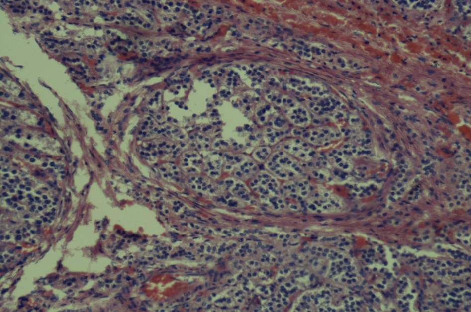 [H & E 40X] Microscopy shows nodules are composed of large polygonal cells