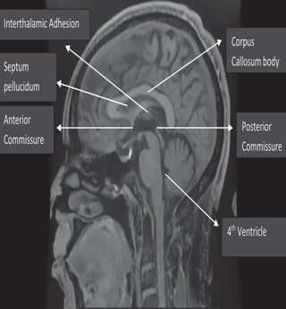Showcases a mid-sagittal magnetic resonance imaging (MRI) scan of the brain, delineating the corpus callosum. 
