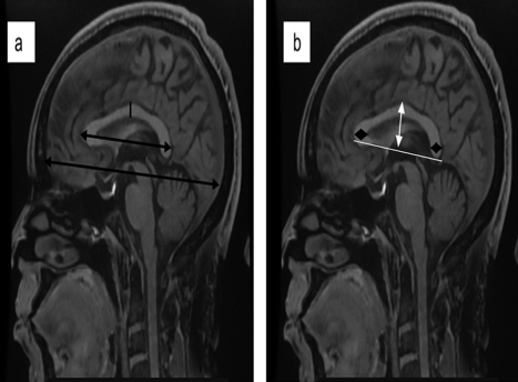 a: Elucidates the anterior-posterior extent of the corpus callosum and the fronto-occipital dimension of the brain, denoted by dual-ended arrows in black; b: The vertical dimension of the corpus callosum is depicted with a white dual-ended arrow, while the thickness of the genu and splenium is highlighted by black diamond-shaped arrows.
